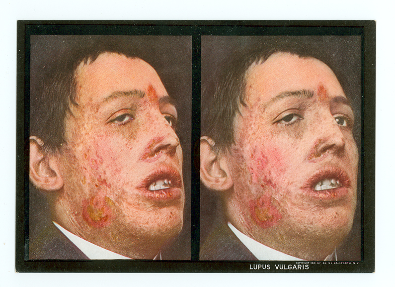 adult_lupus_vulgaris_stereoscopic_skin_clinic_1914-card